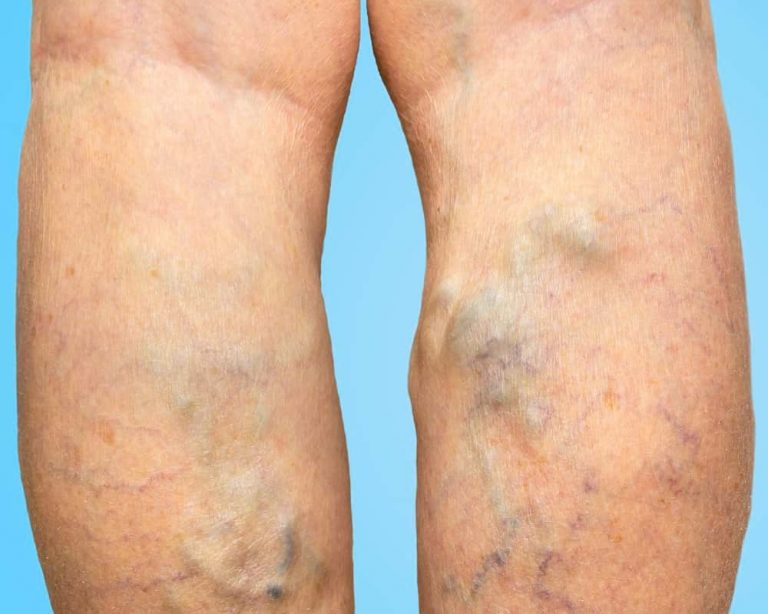 what-kind-of-doctor-treats-varicose-veins