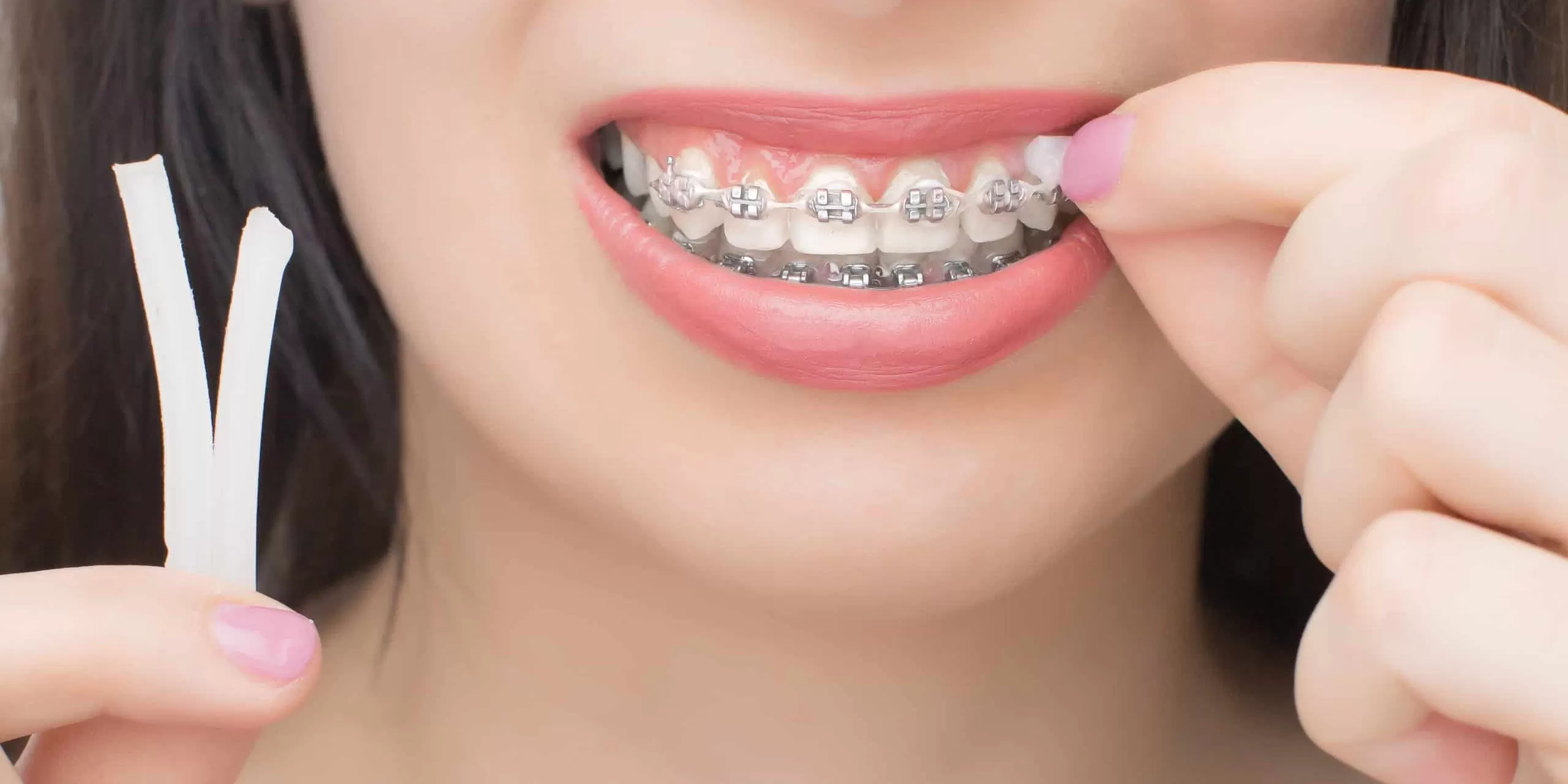 good braces colors